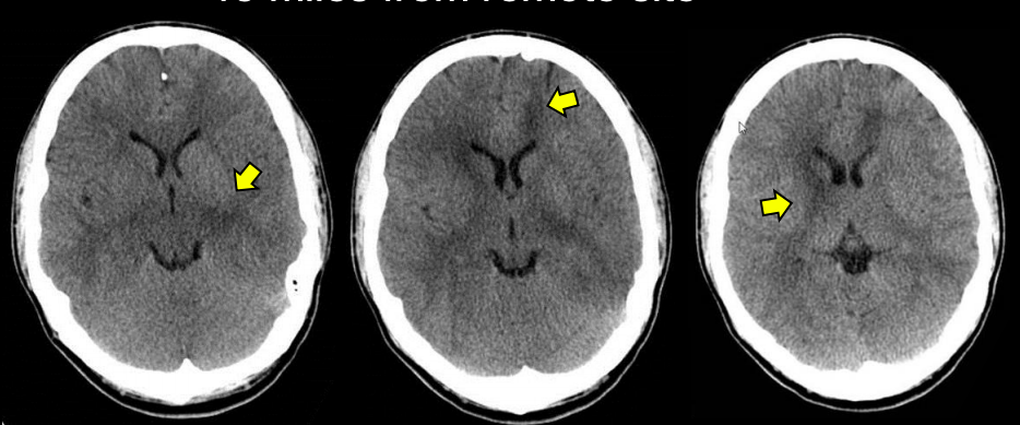 hardware artifact edema