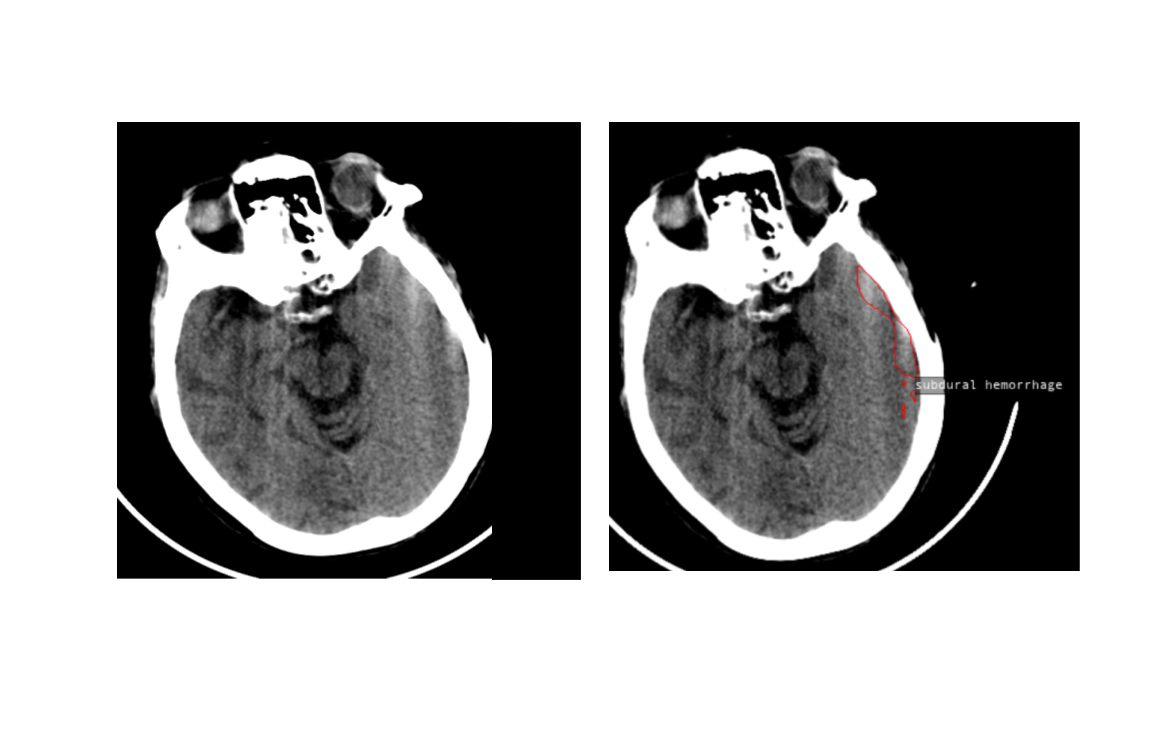 artifact mistaken for sdh