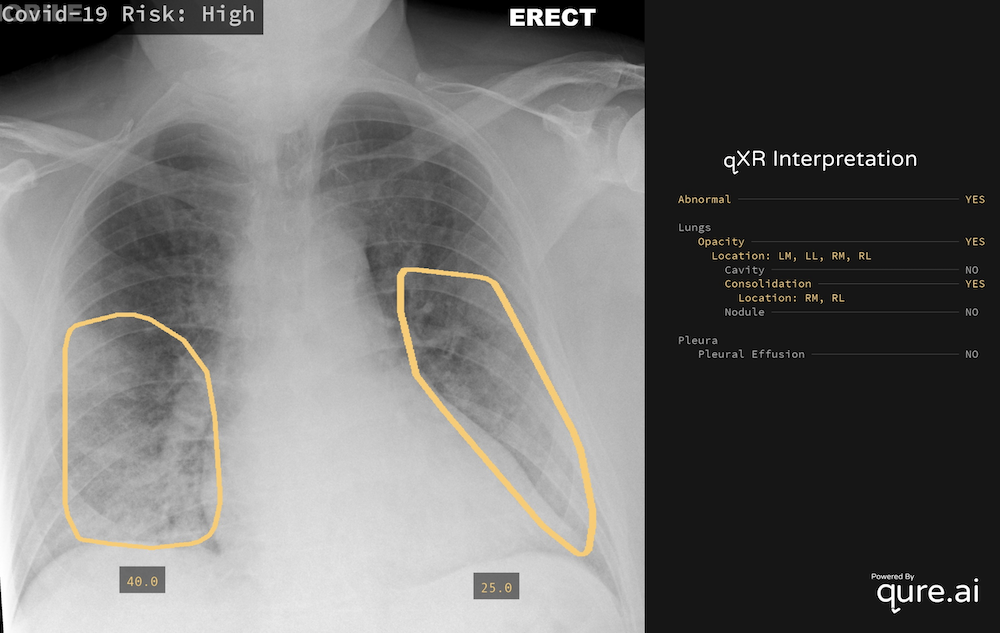 qXR sample